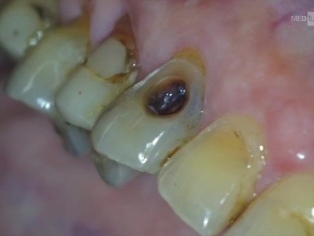 Dostęp endodontyczny do kła szczęki od strony wargowej