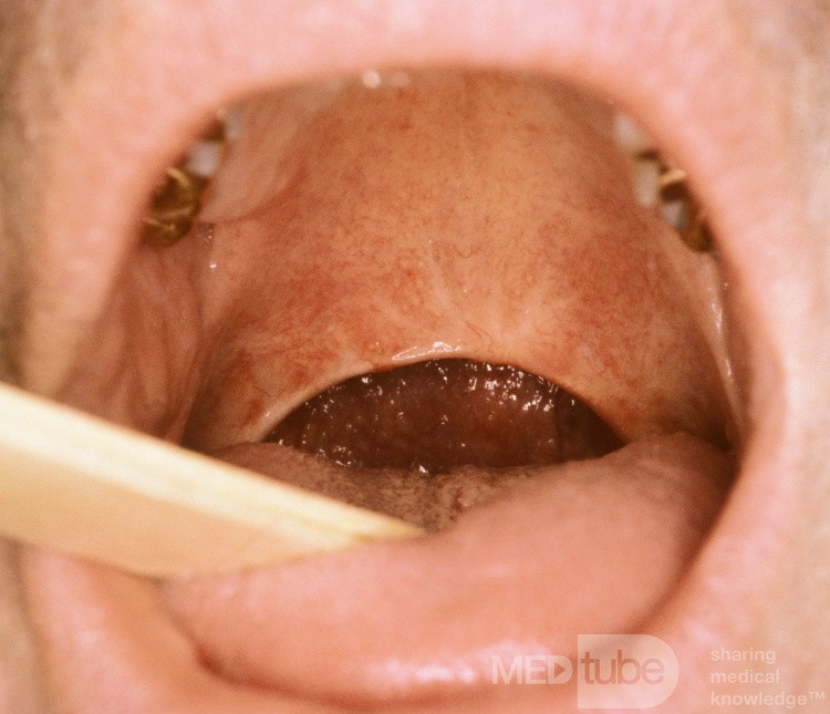 Uwulopalatoplastyka - po operacji