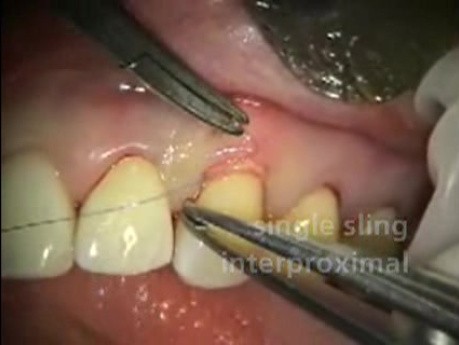 Mikrochirurgia periodontologiczna: przeszczep allogeniczny