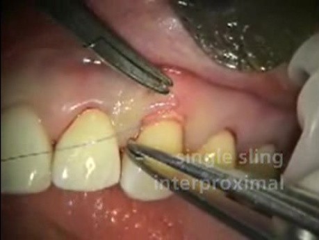 Mikrochirurgia periodontologiczna: przeszczep allogeniczny