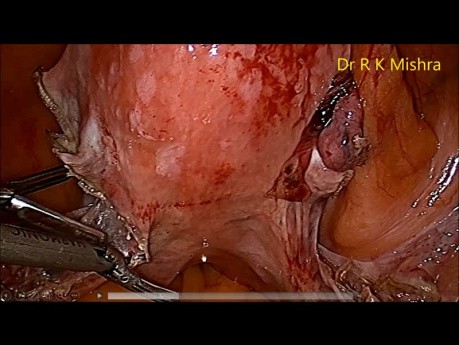 DR R K Mishra Live Stream Lecture- całkowita laparoskopowa histerektomia