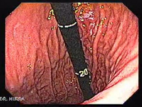 Trzon żołądka - gastroskopia (5 z 6)