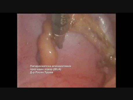 Appendektomią laparoskopowa SIL