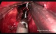 Wideotorakoskopowe usunięcie płata dolnego płuca lewego w technice fissureless