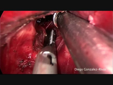 Wideotorakoskopowe usunięcie płata dolnego płuca lewego w technice fissureless