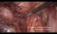 Kompleksowo przeprowadzone adneksektomia z ureterolizą