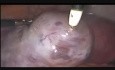 Zespół hiperstymulacji jajników u kobiety przygotowywanej do zapłodnienia in vitro ze zgorzelą obecną w prawym jajniku