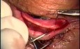Podwinięcie powieki górnej - zabieg operacyjny z ostrzem Fugo