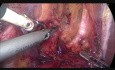 Ureter Duplex