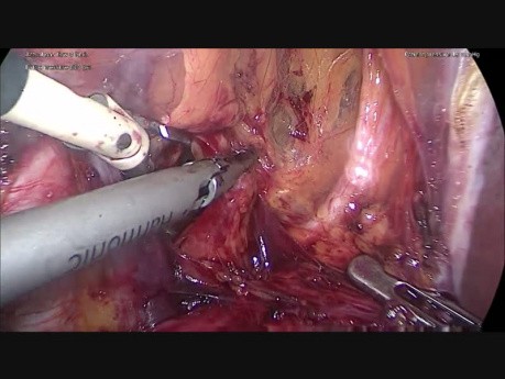 Ureter Duplex