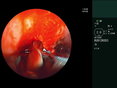 Kriobiopsja pod kontrolą endobronchialnej ultrasonografii (KrioEBUS)