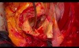 Zastosowanie instrumentów od A do Z w chirurgii łuku aorty