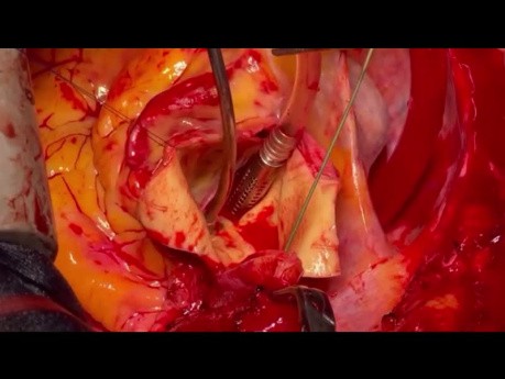 Zastosowanie instrumentów od A do Z w chirurgii łuku aorty