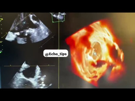 Uszka lewego przedsionka serca - echokardiografia