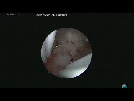 Usunięcie pozostałości płodu z powodu niekompletnego poronienia przy użyciu zimnego noża podczas histeroskopii
