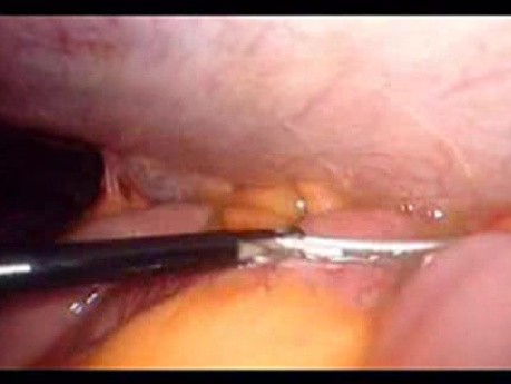 Perforacja okrężnicy z zapaleniem otrzewnej - laparoskopia (34 z 46)