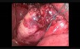 Chirurgia minilaparoskopowa - drugie "Reduced Port Surgery Forum"