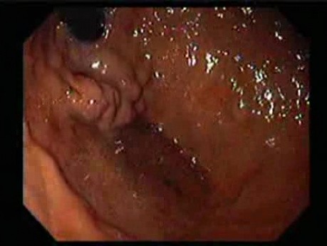 Żylaki żołądka - endoskopowa ablacja klejem cyjanoakrylowym (4 z 18)