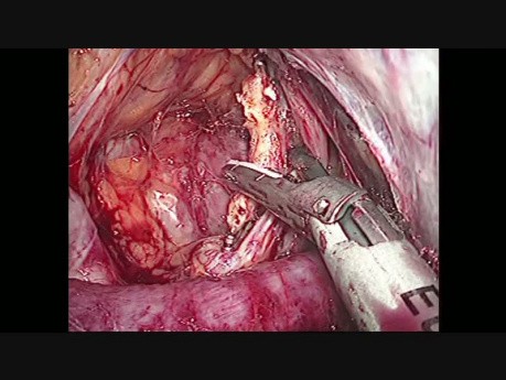 Adrenalektomia laparoskopowa 