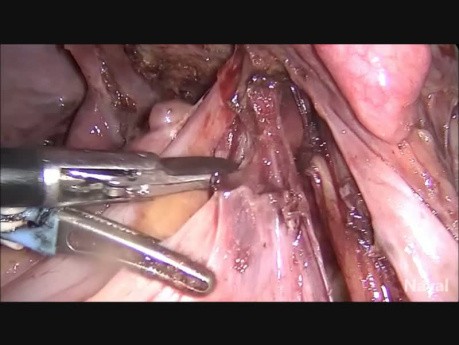 Całkowita laparoskopowa histerektomia i obustronna adneksektomia w przypadku zamrożenia miednicy i głębokiej endometriozy