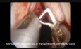 Technika Microflap (MLE) - polip naczyniakowaty lewej struny głosowej 