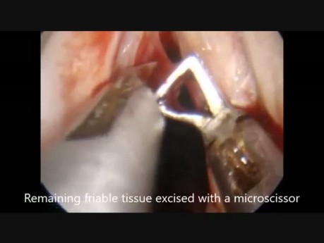 Technika Microflap (MLE) - polip naczyniakowaty lewej struny głosowej 