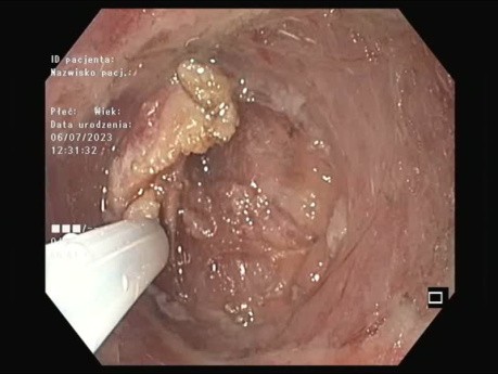 Płaski gruczolak żołądka (Paris 0-IIb) - resekcja endoskopowa