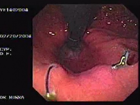 Endoskopowe szycie wewnątrz światła - obraz dwóch guzków w inwersji endoskopowej, część 1