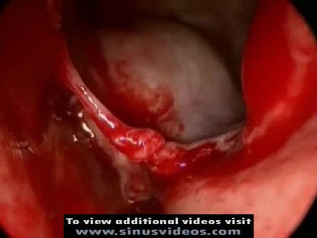 Endoskopowe usunięcie torbieli śluzowej kości sitowej
