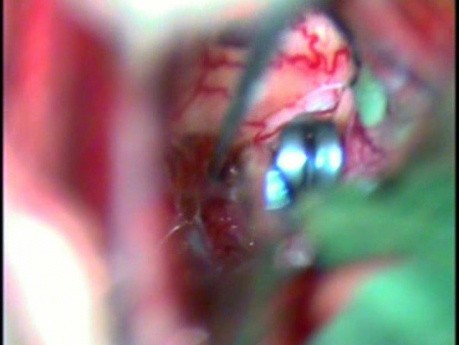 Klipsowanie tętniaka tętnicy łączącej przedniej