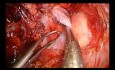 Bilobektomia z dojścia przez worek osierdziowy (Intrapericardial) z częściową resekcją żyły głównej górnej metodą Uniportal VATS