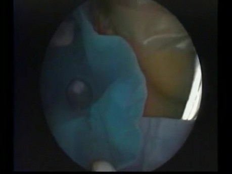 Endoskopowy drenaż hipoplastycznej zatoki szczękowej (typu II)