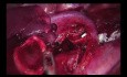 Wideotorakoskopowa rękawowa lobektomia z jednego cięcia (film bez edycji)