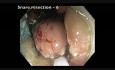 Kolonoskopia: endoskopowa resekcja śluzówkowa dużej płaskiej zmiany w okrężnicy wstępującej