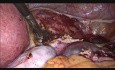 TLH (totalna laparoskopowa histerektomia) z powodu mięśniaka macicy wielkości 30 tygodniowego płodu