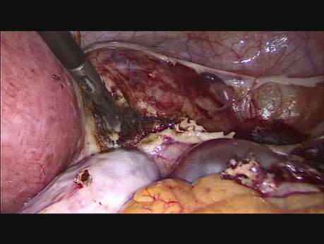 TLH (totalna laparoskopowa histerektomia) z powodu mięśniaka macicy wielkości 30 tygodniowego płodu