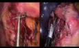 Laparo-endoskopowa jednomiejscowa (LESS) fundoplikacja Nissena, wykorzystanie rewolucyjnej technologii szycia