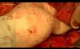 Hemikolektomia prawostronna z powodu olbrzymiego guza jamy brzusznej (sarkoma)