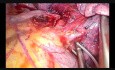 Trik ułatwiający przecięcie żył górnego płata płuca poczas zabiegu videotoraskopowego