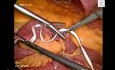 Laparoskopowa operacja torbieli dróg żółciowych