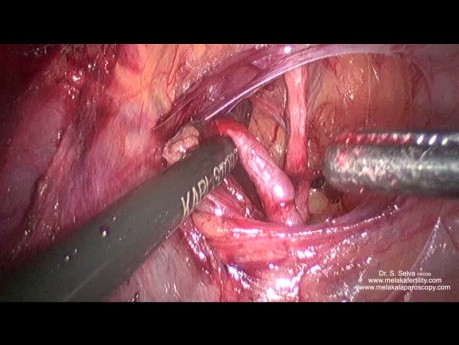 Dyssekcja przednia i ligacja tętnicy macicznej przy znacznej wielkości macicy