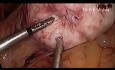 Miomektomia laparoskopowa przy zastosowaniu techniki "Mishra’s KNOT"