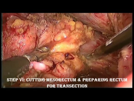 Niska przednia resekcja odbytnicy (LAR) metodą laparoskopową