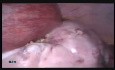 Usunięcie dużej torbieli jajnika metodą laparoskopową w 18. tygodniu ciąży 