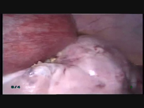 Usunięcie dużej torbieli jajnika metodą laparoskopową w 18. tygodniu ciąży 