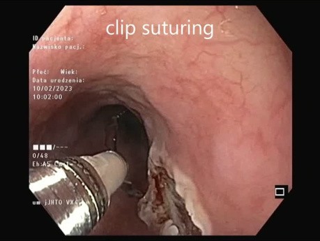 Endoskopowa resekcja guza podśluzówkowego przełyku