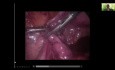 Laparoskopia w ciąży pozamacicznej - Tubal Milking
