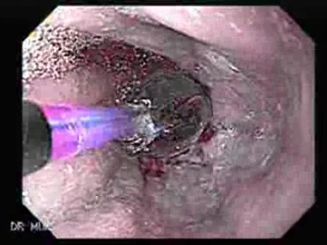 Endoskopowa Balonowa Dylatacja Zwężenia Przełyku  - Wersja Przyspieszona