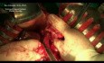 Operacja guza stromalnego (GIST) żołądka