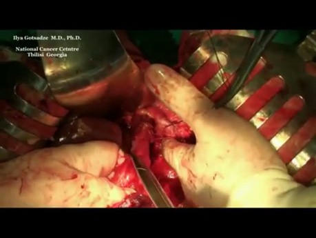 Operacja guza stromalnego (GIST) żołądka